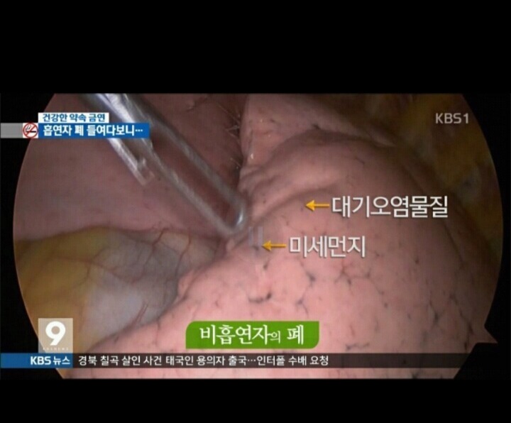 흡연자의 폐 . jpg | 인스티즈
