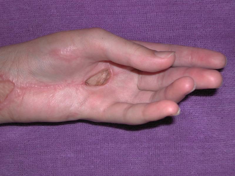 혐오))적나라함 주의)) 방울뱀에게 물린 사람의 치료과정 | 인스티즈