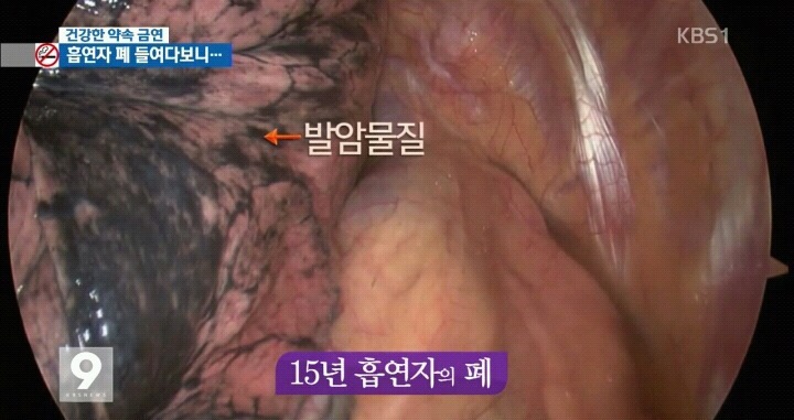 흡연자들의 폐 내시경.jpg (사진주의) | 인스티즈