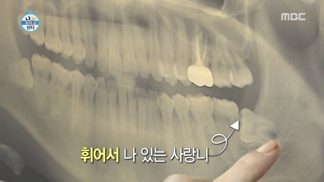 [나혼자산다] 너도나도 공감하는 공포의 사랑니 빼기 | 인스티즈